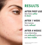 VICHY NORMADERM ACNE-PRONE SKIN SOIN CORRECTEUR ANTI-IMPERFECTION MATIFIANT 50ML